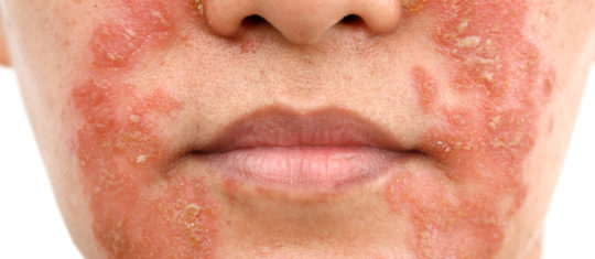 psoriasis