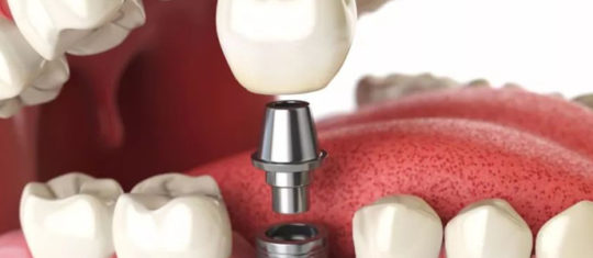 Implant dentaire avec couronne