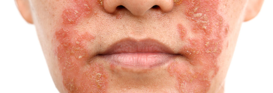 Plaque De Psoriasis Sur Le Visage