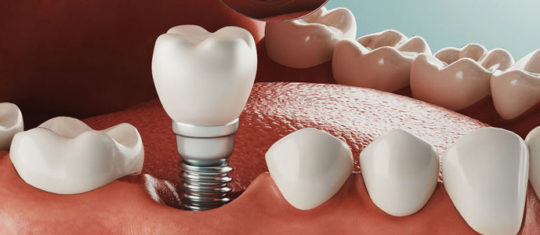 Implant dentaire à Paris
